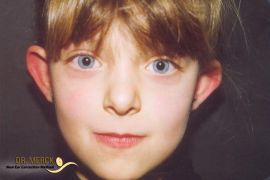 Abstehende Ohren vor OP - Bild 3